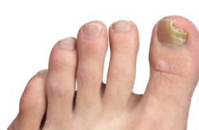 Лечение грибка ногтей народными средствами